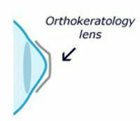 OrthoKeratology Lenses